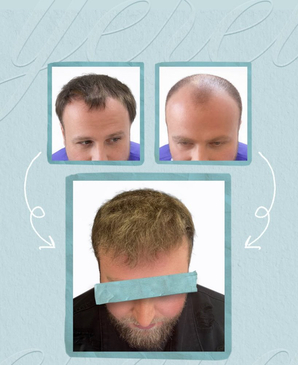 Slider image (2) United Hair Clinic